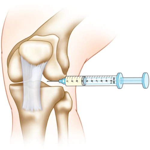 intra-articular-injections